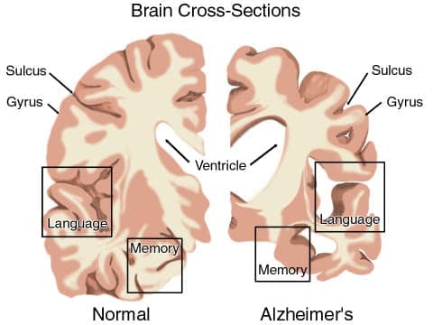 Alzheimer’s Disease