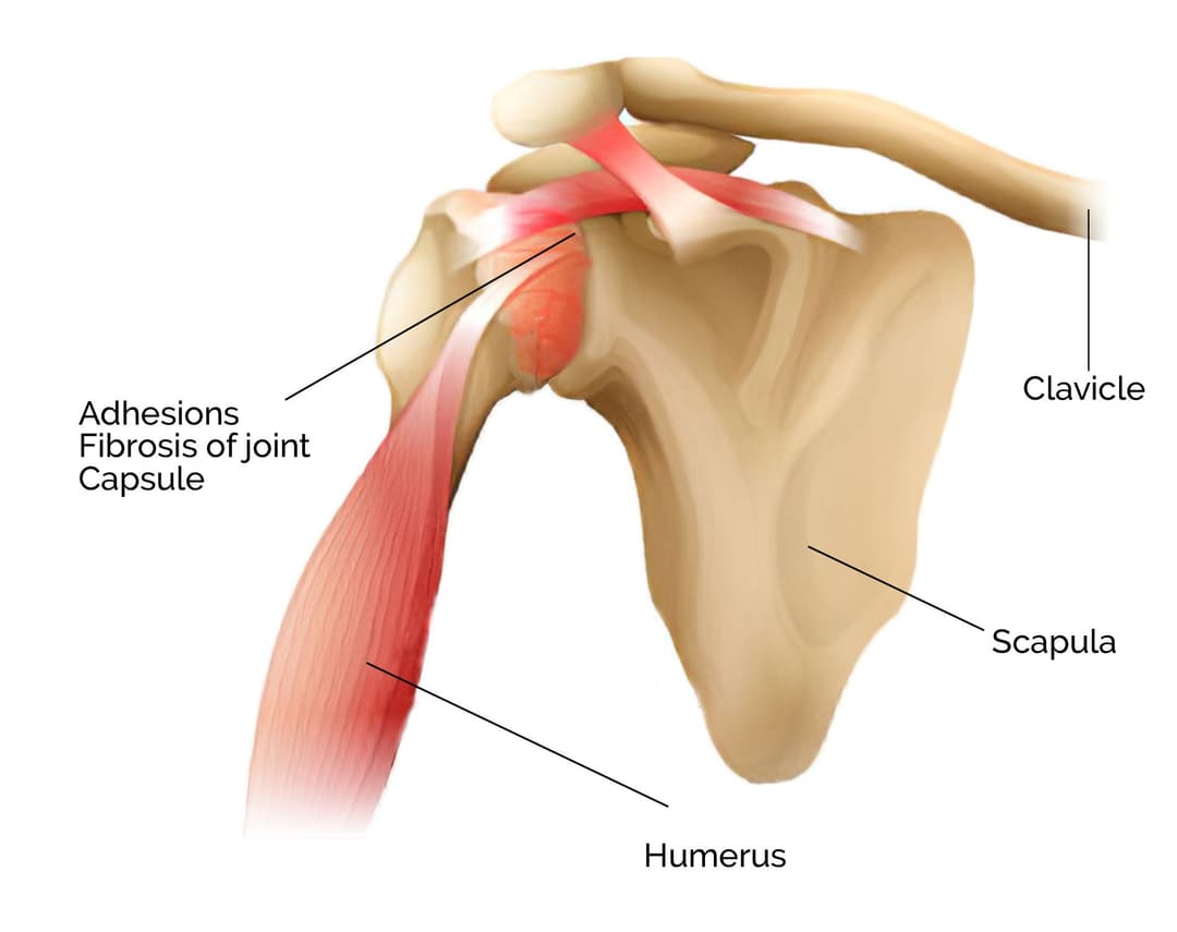 Shoulder Pain