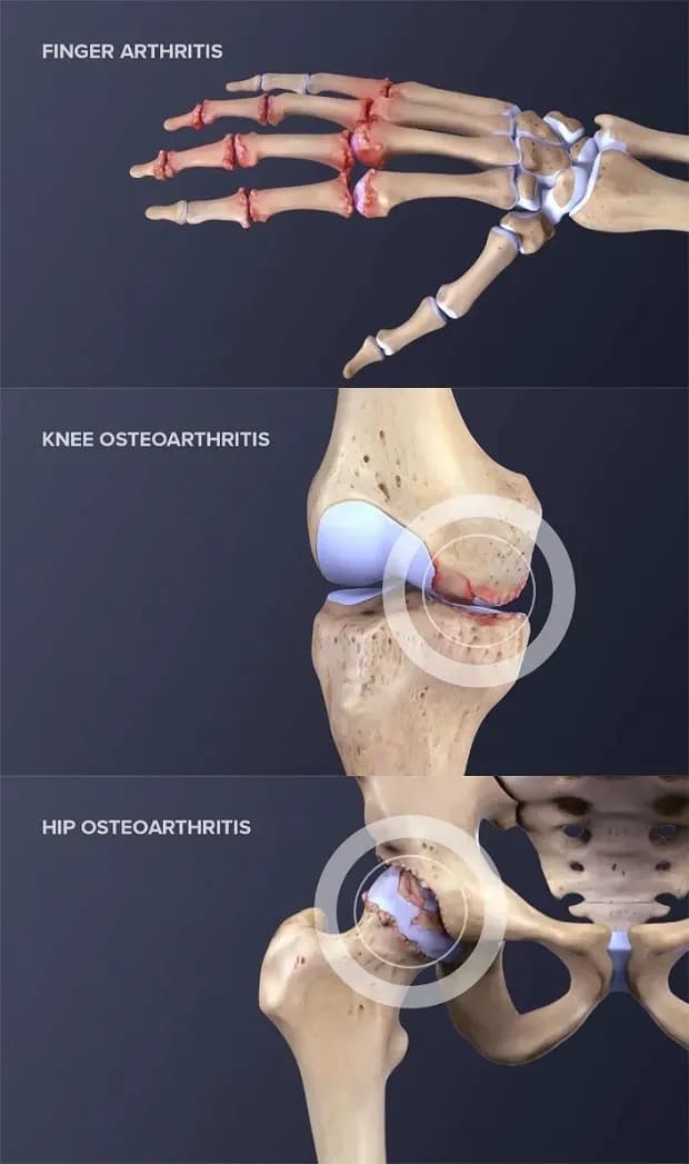 Arthritis Indication Treated in Concord Stem Cell.webp