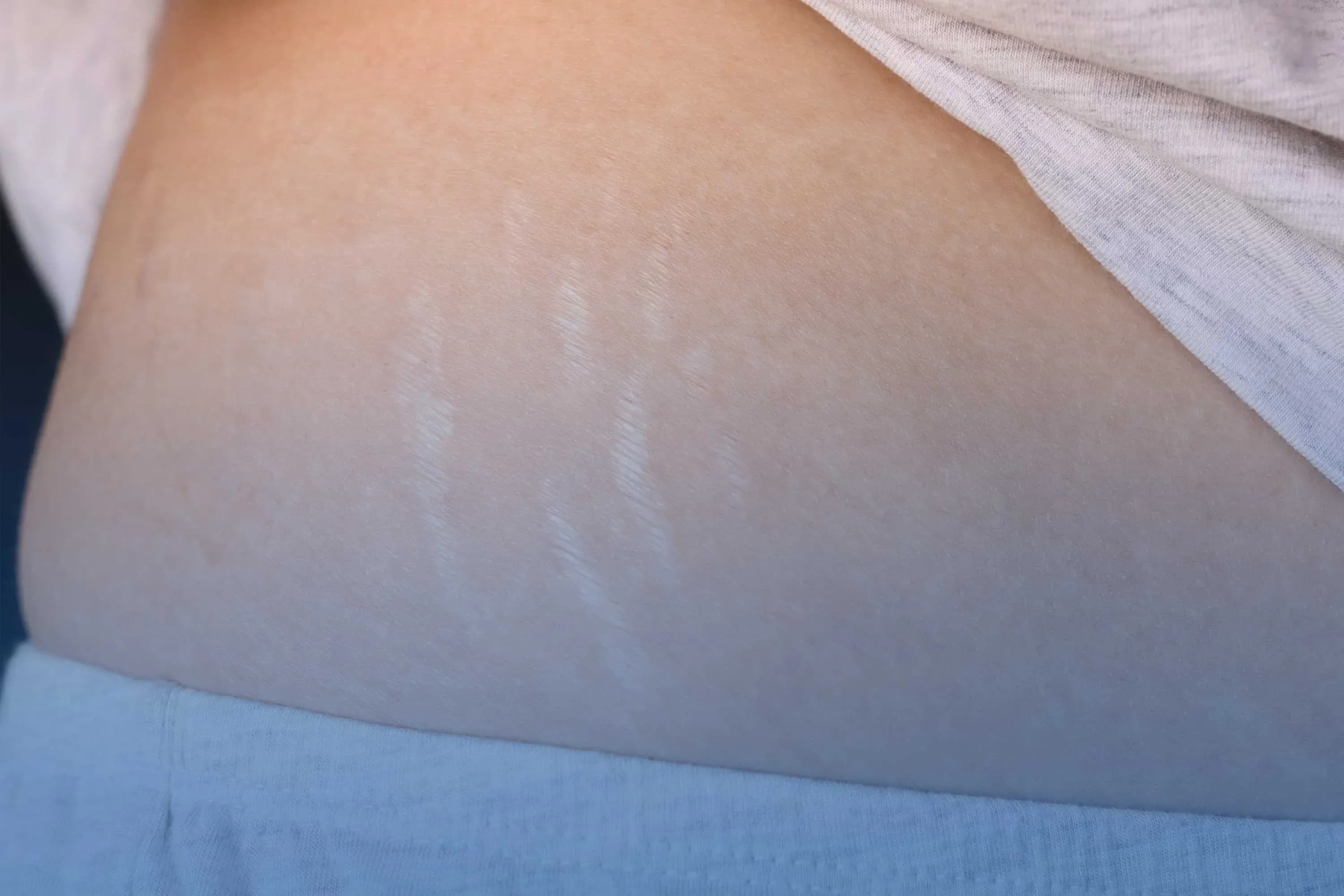 Stretch marks